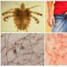 Effective remedies and cures for pubic lice Pubic lice folk remedies